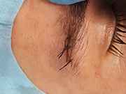 Sutura boxeo ceja ambulancia